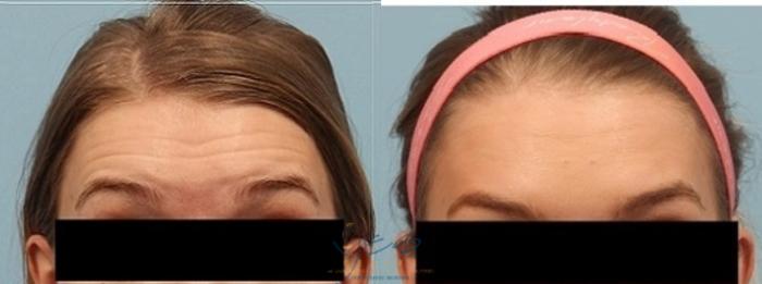 Before & After BOTOX COSMETIC® Treatments Case 250 Raised Brow View in Vancouver, BC