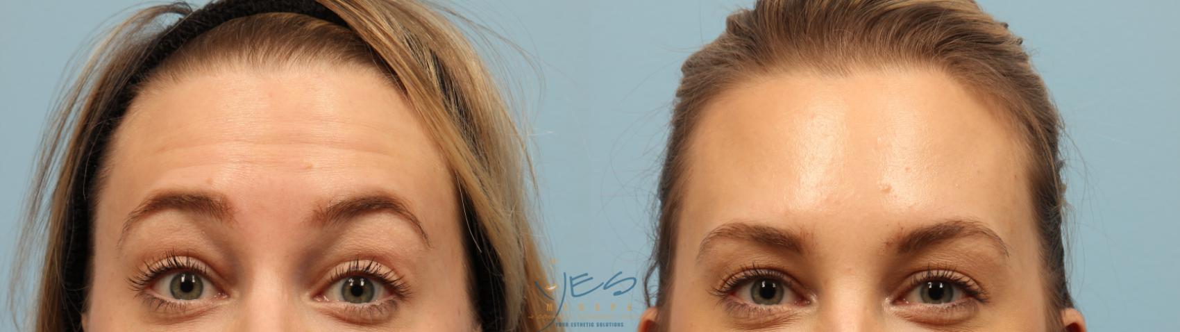 Botox Cosmetic® Treatments Before And After Photo Gallery Vancouver Bc Yes Medspa And Cosmetic 