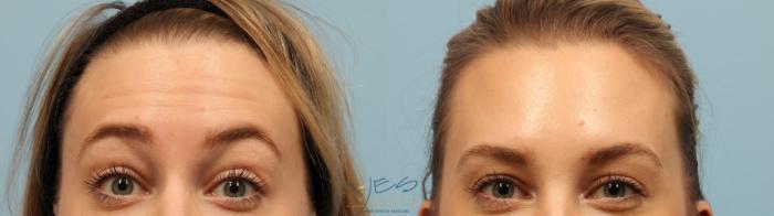 Before & After BOTOX COSMETIC® Treatments Case 326 Front View in Vancouver, BC