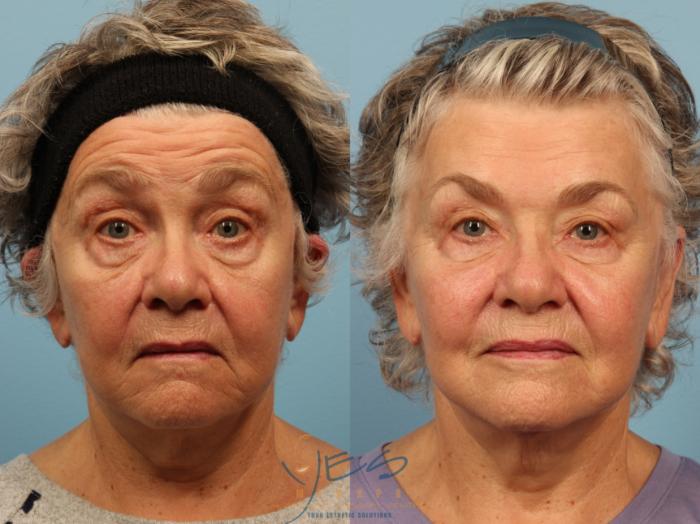 Before & After BOTOX COSMETIC® Treatments Case 357 Eyebrows Up View in Vancouver, BC