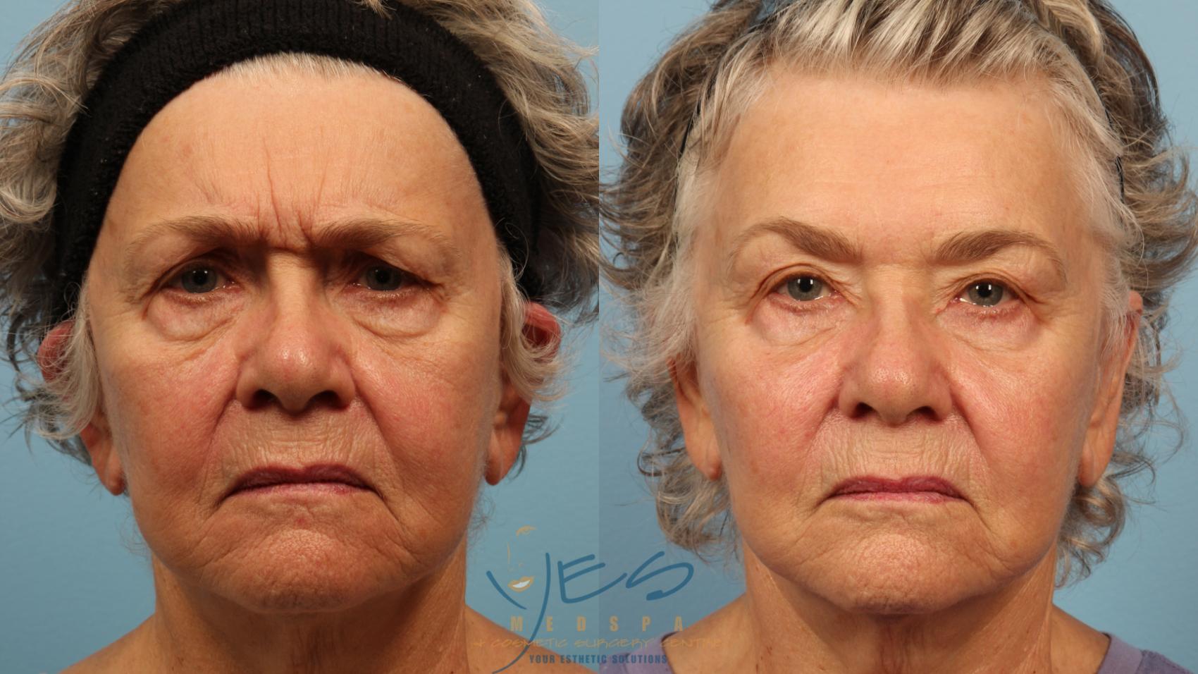 Before & After BOTOX COSMETIC® Treatments Case 357 Frown View in Vancouver, BC
