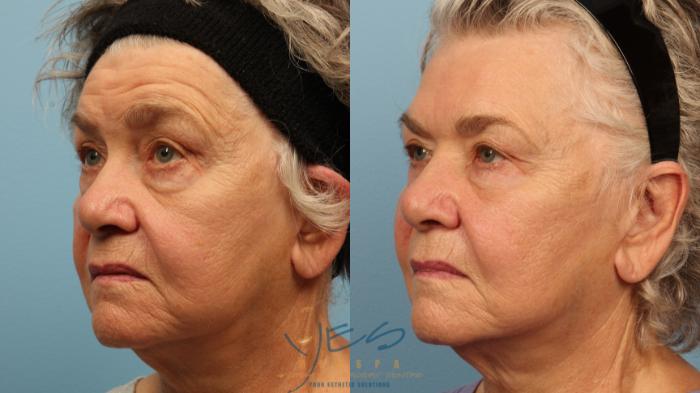 Before & After Dermal Fillers Case 357 Left Oblique View in Vancouver, BC