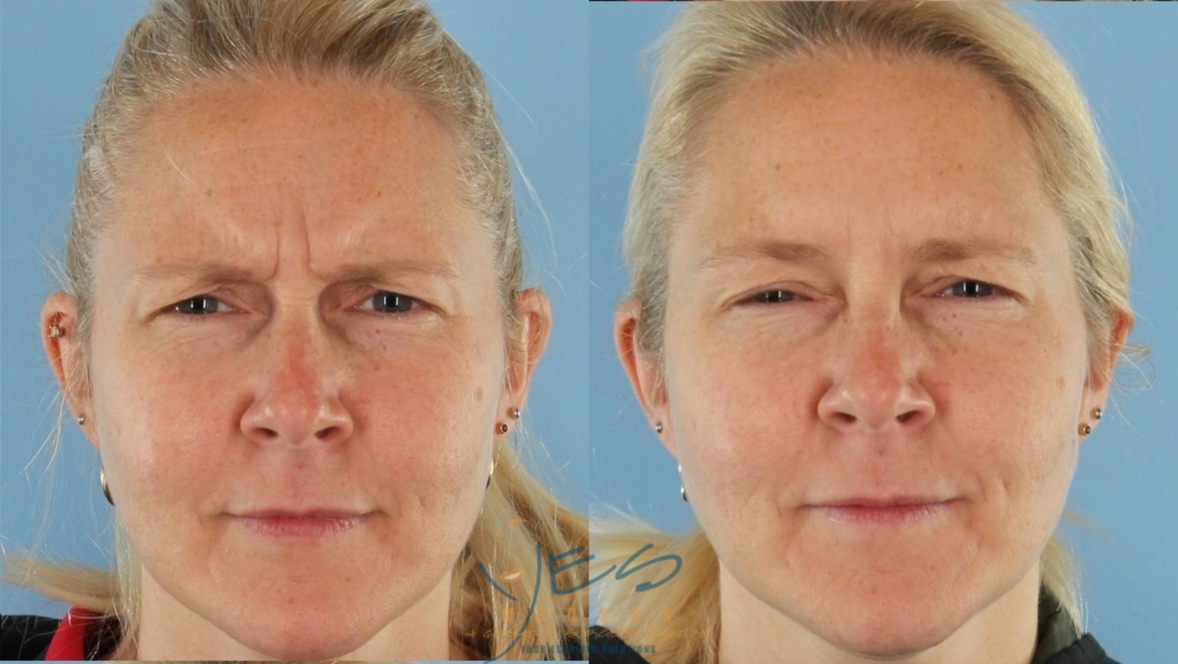 Patient Before After BOTOX COSMETIC Treatment   Botox Cosmetic Treatments 407 Front Frown Detail 