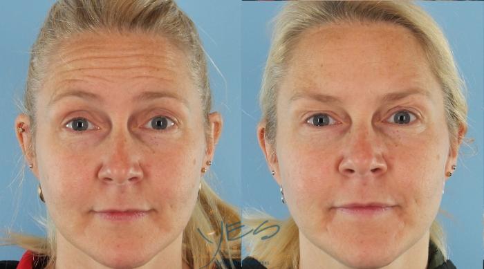 Before & After BOTOX COSMETIC® Treatments Case 407 Front - Raised Brow View in Vancouver, BC
