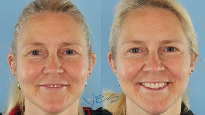 Before & After BOTOX COSMETIC® Treatments Case 407 Front - Smile View in Vancouver, BC