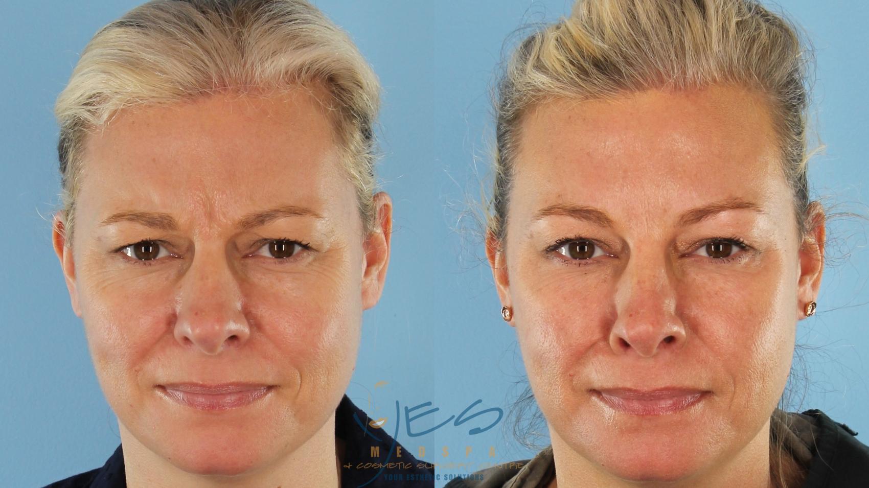 Before & After BOTOX COSMETIC® Treatments Case 413 Front - Frown View in Vancouver, BC