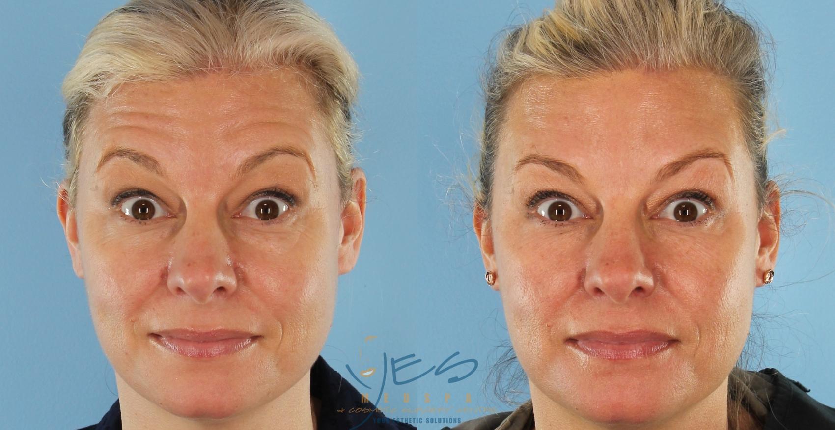 Before & After BOTOX COSMETIC® Treatments Case 413 Front - Raised Brow View in Vancouver, BC