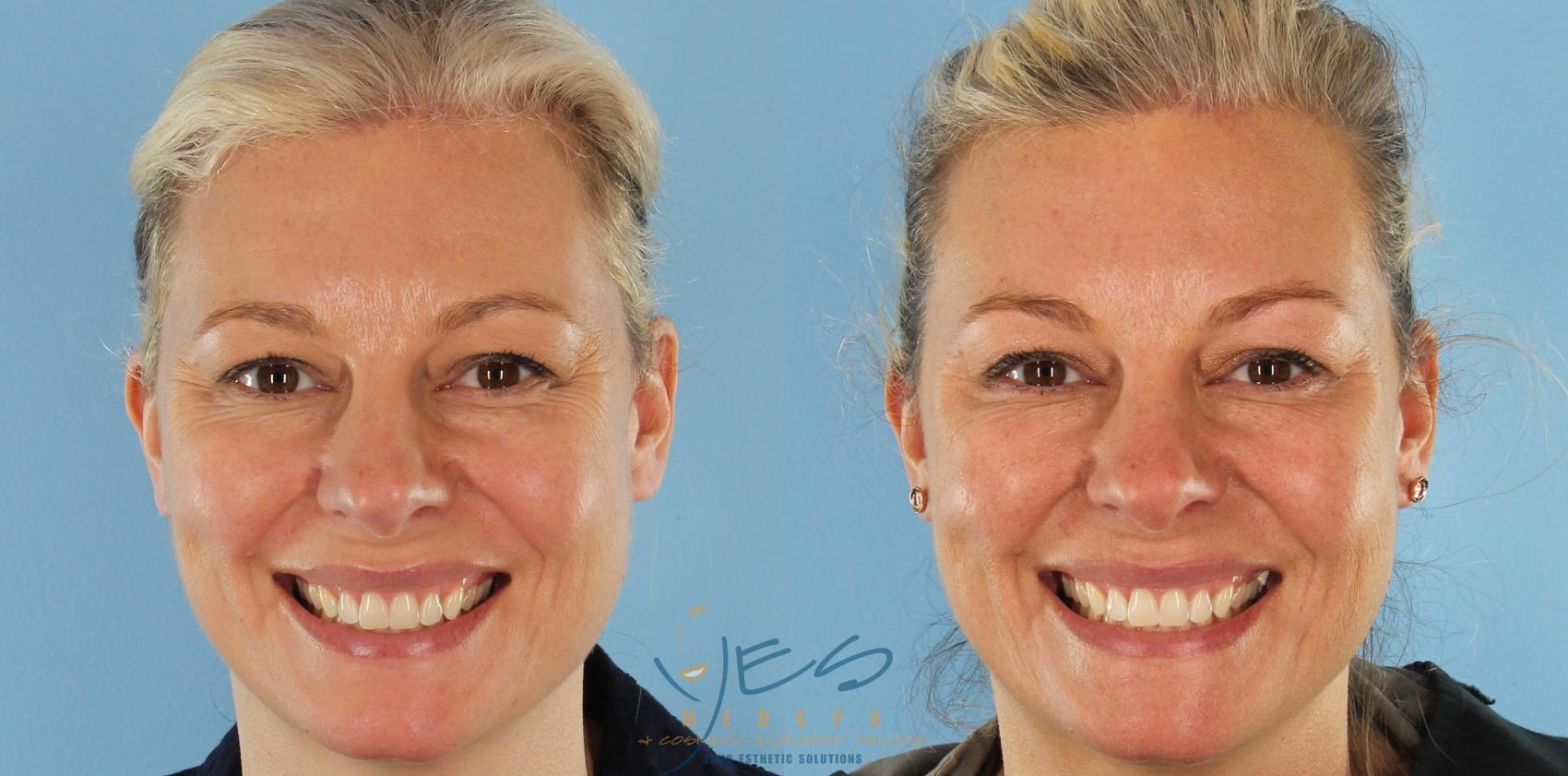 Before & After BOTOX COSMETIC® Treatments Case 413 Front - Smile View in Vancouver, BC