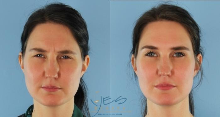Before & After BOTOX COSMETIC® Treatments Case 415 Front - Frown View in Vancouver, BC