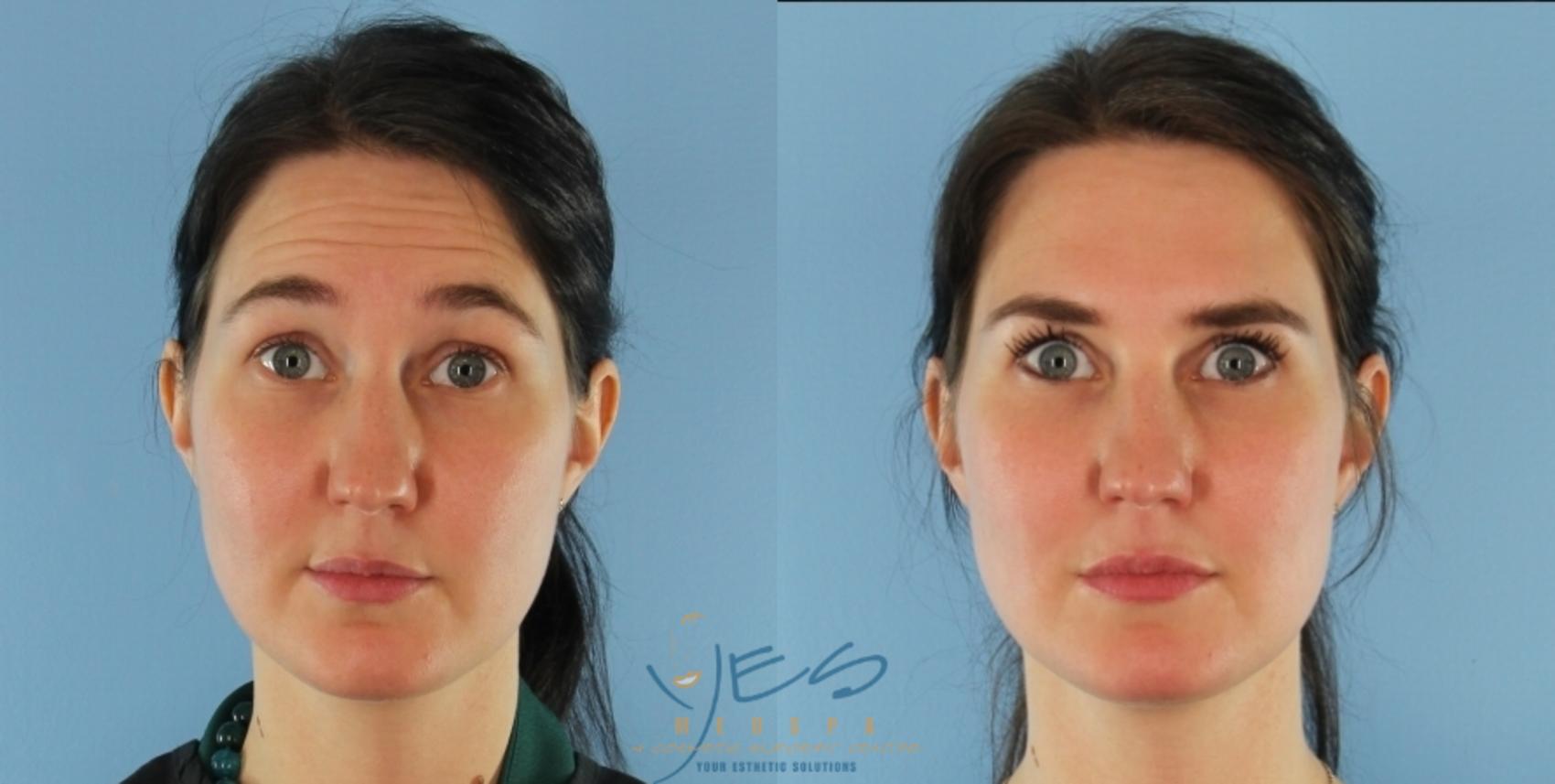Before & After Dermal Fillers Case 415 Front - Raised Brow View in Vancouver, BC