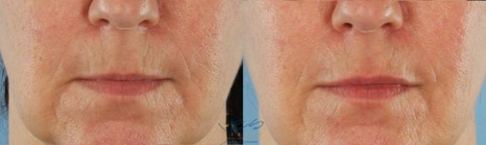 Before & After BOTOX COSMETIC® Treatments Case 420 Front View in Vancouver, BC