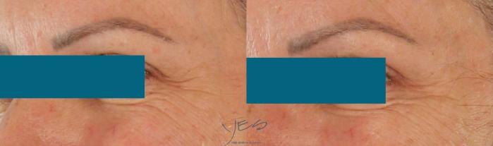 Before & After BOTOX COSMETIC® Treatments Case 420 Left Oblique View in Vancouver, BC