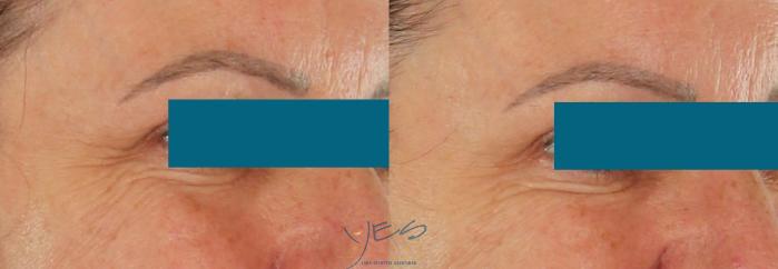 Before & After BOTOX COSMETIC® Treatments Case 420 Right Oblique View in Vancouver, BC