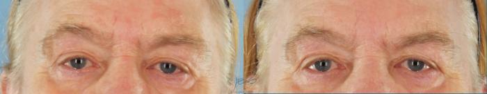 Before & After BOTOX COSMETIC® Treatments Case 435 Front - Neutral View in Vancouver, BC