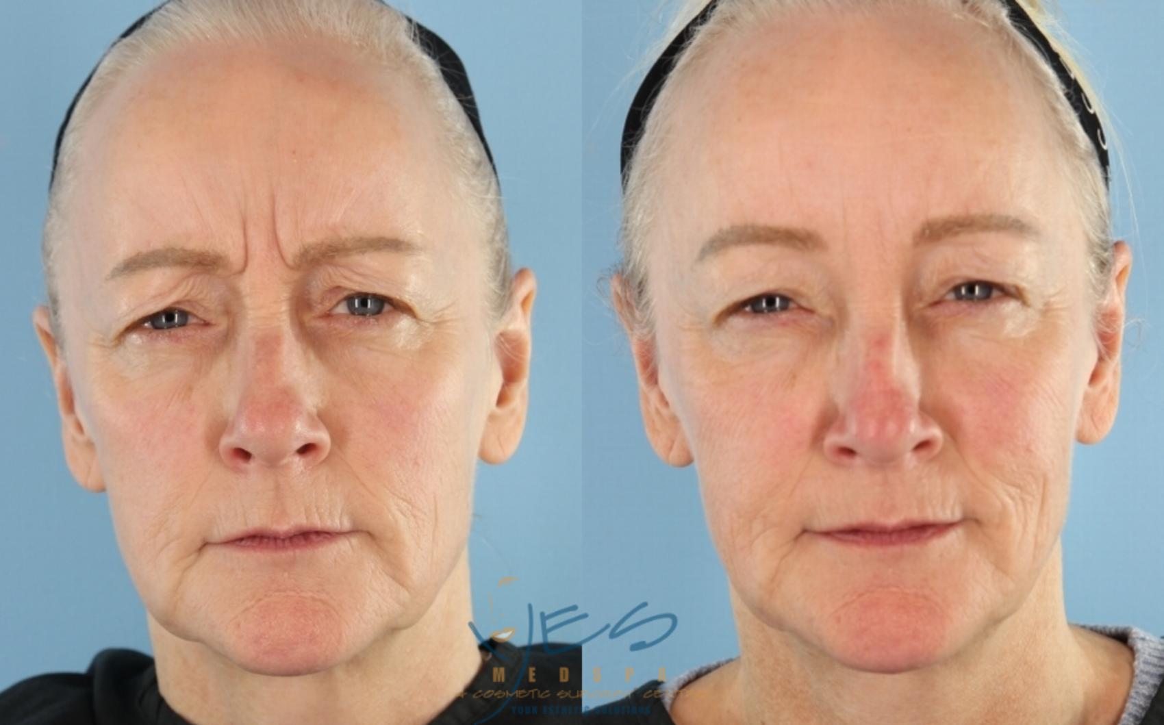 Before & After BOTOX COSMETIC® Treatments Case 444 Front Frown View in Vancouver, BC