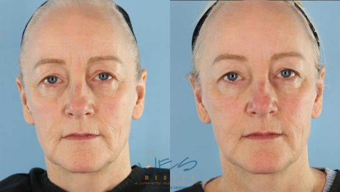 Before & After BOTOX COSMETIC® Treatments Case 444 Front Neutral View in Vancouver, BC