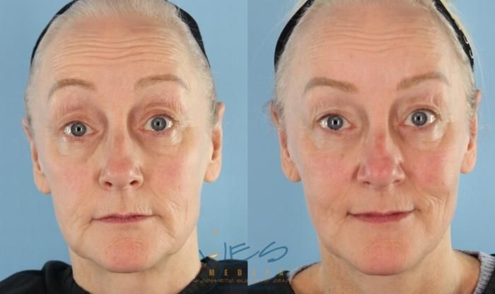 Before & After BOTOX COSMETIC® Treatments Case 444 Front Raised Brow View in Vancouver, BC