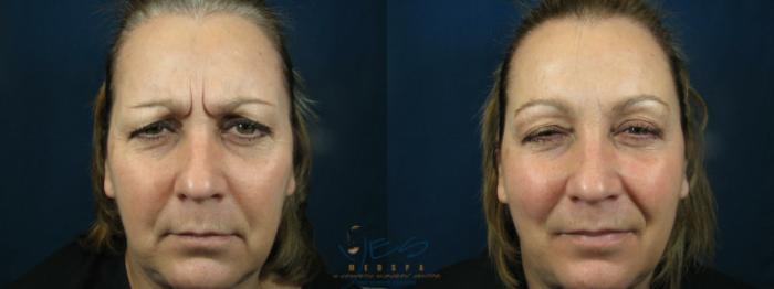 Before & After BOTOX COSMETIC® Treatments Case 80 Frown View in Vancouver, BC