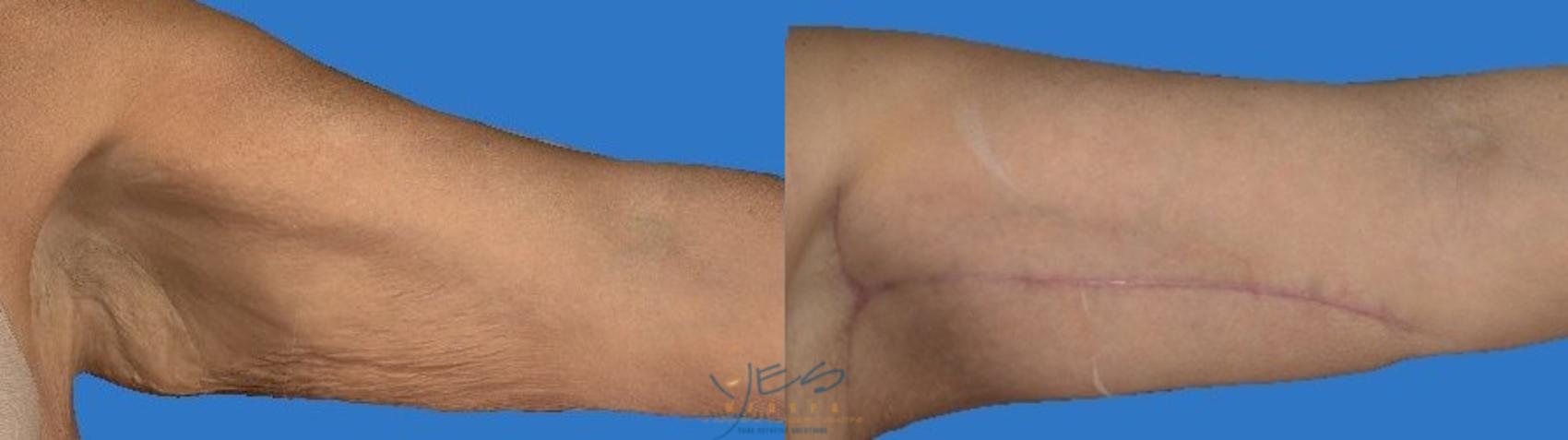 Before & After Brachioplasty Case 112 Left Side View in Vancouver, BC
