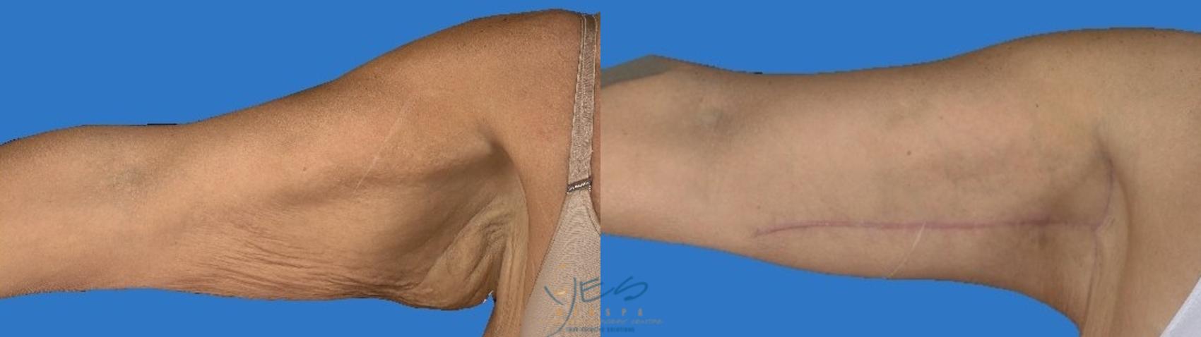 Before & After Brachioplasty Case 112 Right Side View in Vancouver, BC