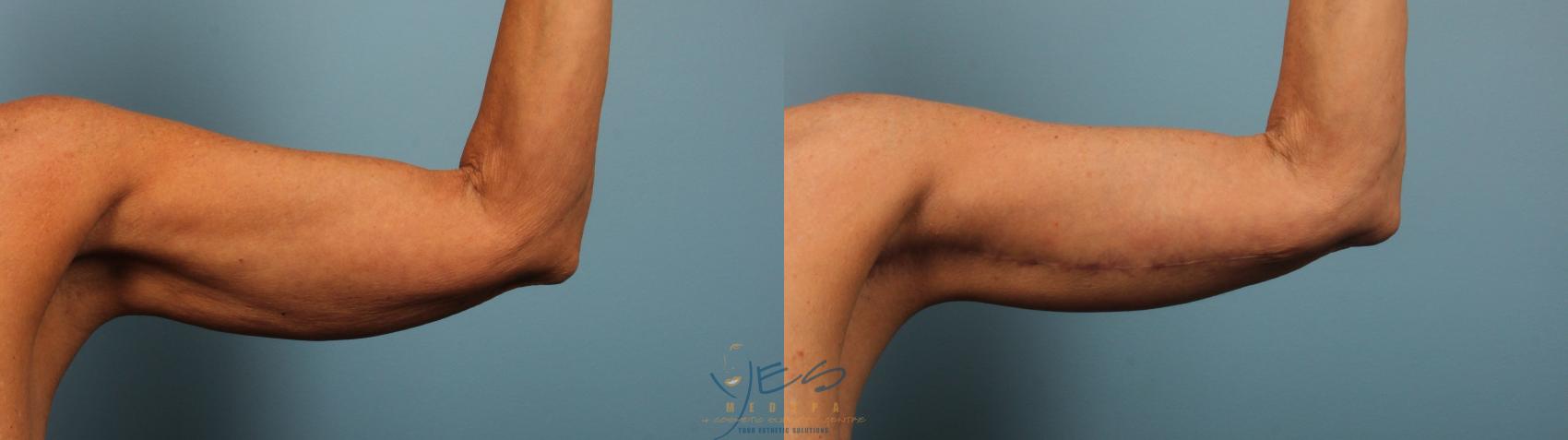 Before & After Brachioplasty Case 258 Front View in Vancouver, BC