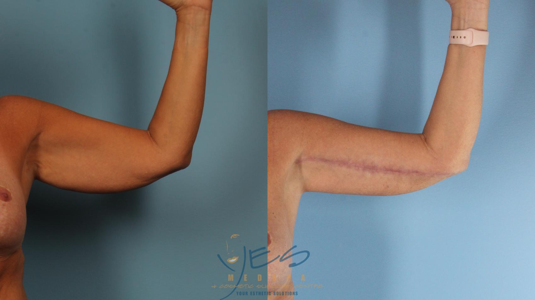 Before & After Brachioplasty Case 377 Left Side View in Vancouver, BC