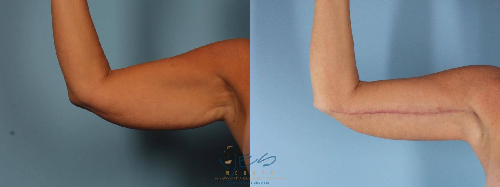Before & After Brachioplasty Case 377 Right Side View in Vancouver, BC