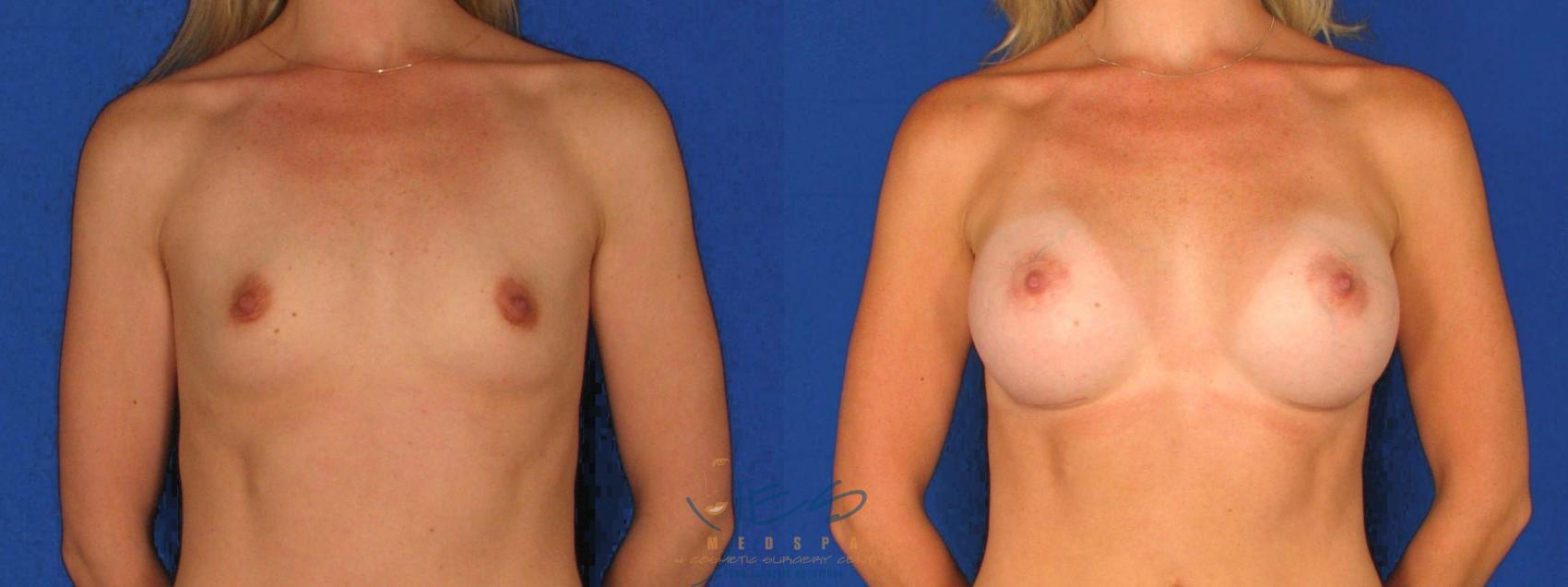 Before & After Breast Augmentation Case 10 Front View in Vancouver, BC