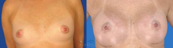 Before & After Breast Augmentation Case 100 Front View in Vancouver, BC
