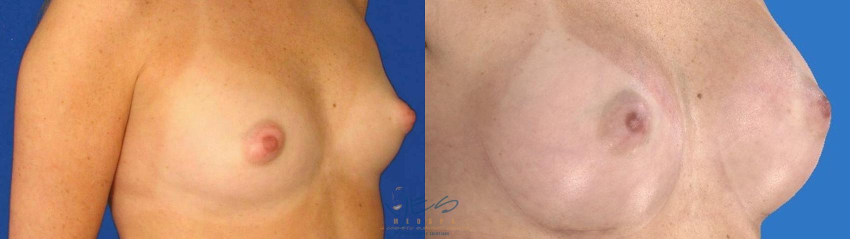 Before & After Breast Augmentation Case 100 Right Oblique View in Vancouver, BC