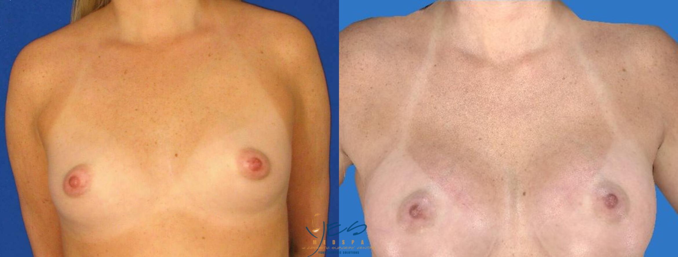 Breast Augmentation Case 100 Before & After View #1 | Langley, BC | YES Medspa & Cosmetic Surgery Centre