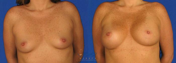 Before & After Breast Augmentation Case 104 View #1 View in Vancouver, BC
