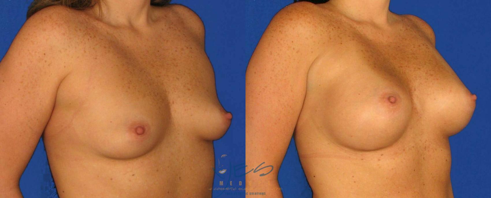 Before & After Breast Augmentation Case 104 View #2 View in Vancouver, BC