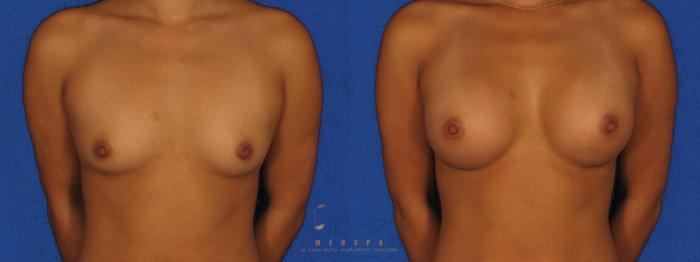 Before & After Breast Augmentation Case 11 Front View in Vancouver, BC