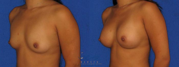 Before & After Breast Augmentation Case 11 Left Oblique View in Vancouver, BC