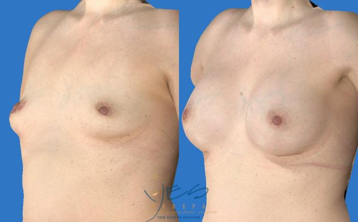 Before & After Breast Augmentation Case 114 View #1 View in Vancouver, BC