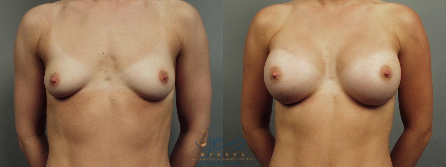Before & After Breast Augmentation Case 12 Front View in Vancouver, BC