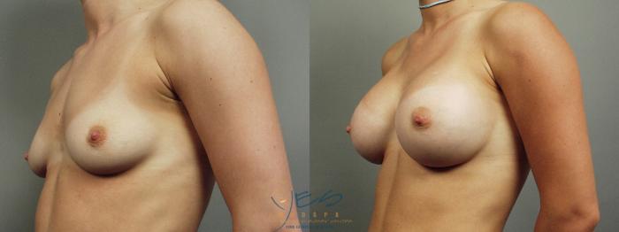 Before & After Breast Augmentation Case 12 Left Oblique View in Vancouver, BC
