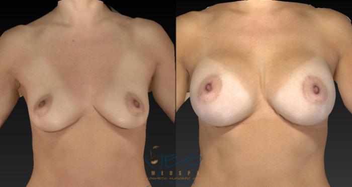 Before & After Breast Augmentation Case 127 View #1 View in Vancouver, BC