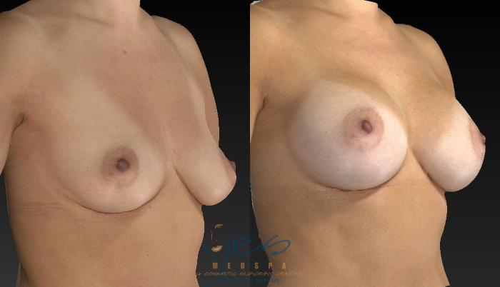 Before & After Breast Augmentation Case 127 View #2 View in Vancouver, BC