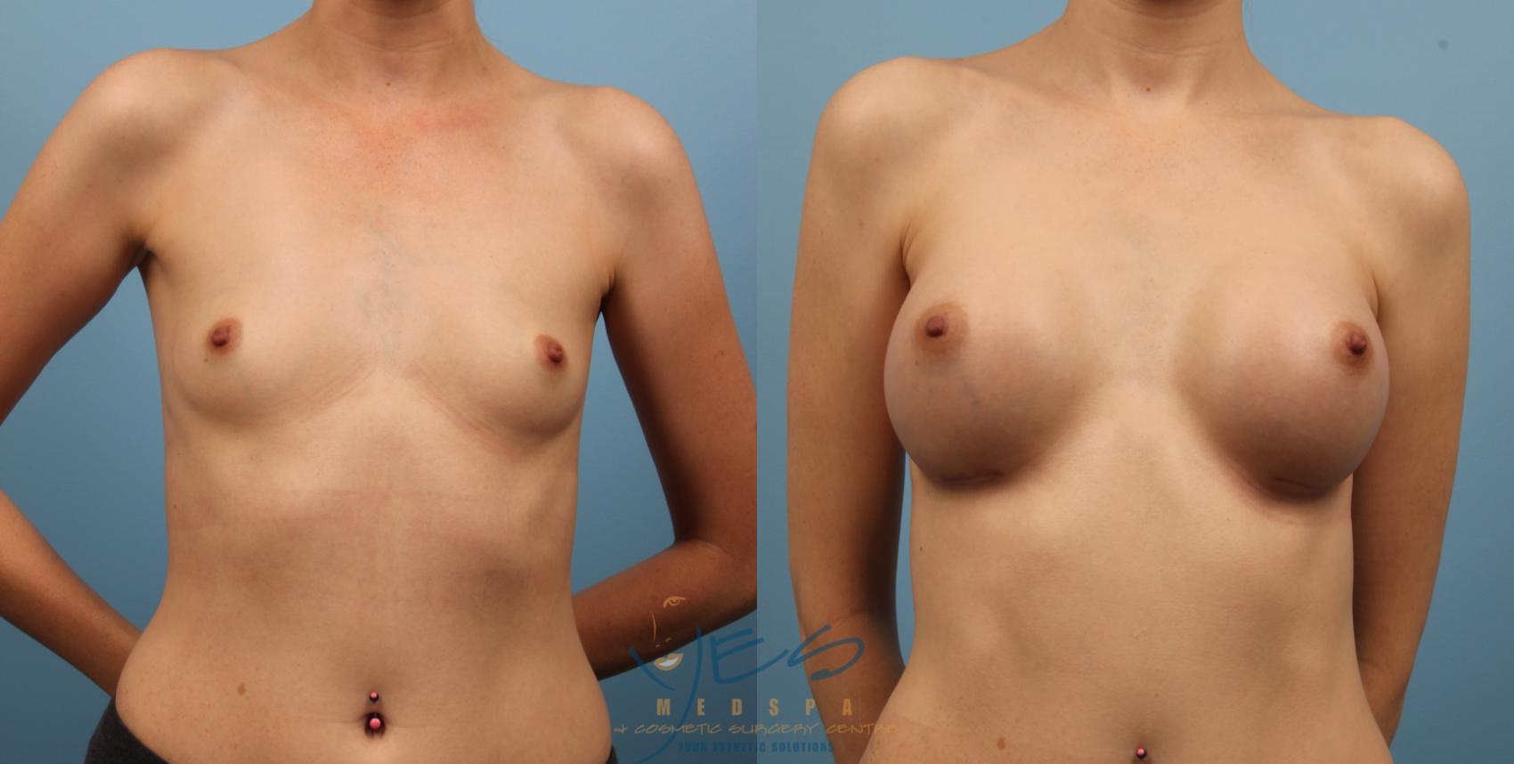 Before & After Breast Augmentation Case 132 View #1 View in Vancouver, BC