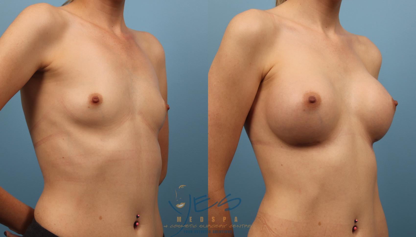 Before & After Breast Augmentation Case 132 View #2 View in Vancouver, BC