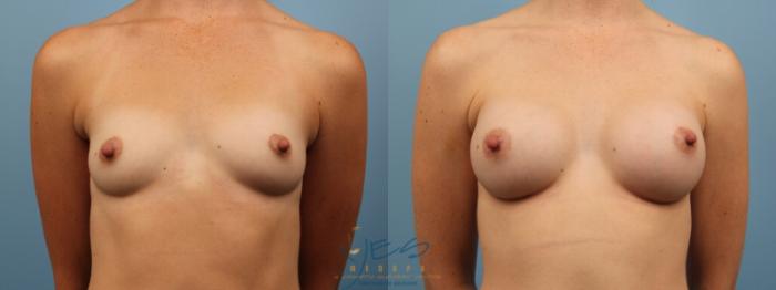 Before & After Breast Augmentation Case 133 View #1 View in Vancouver, BC
