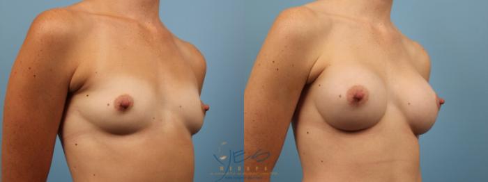 Before & After Breast Augmentation Case 133 View #2 View in Vancouver, BC