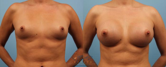 Before & After Breast Augmentation Case 140 View #1 View in Vancouver, BC
