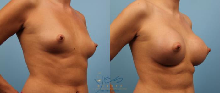 Before & After Breast Augmentation Case 140 View #2 View in Vancouver, BC