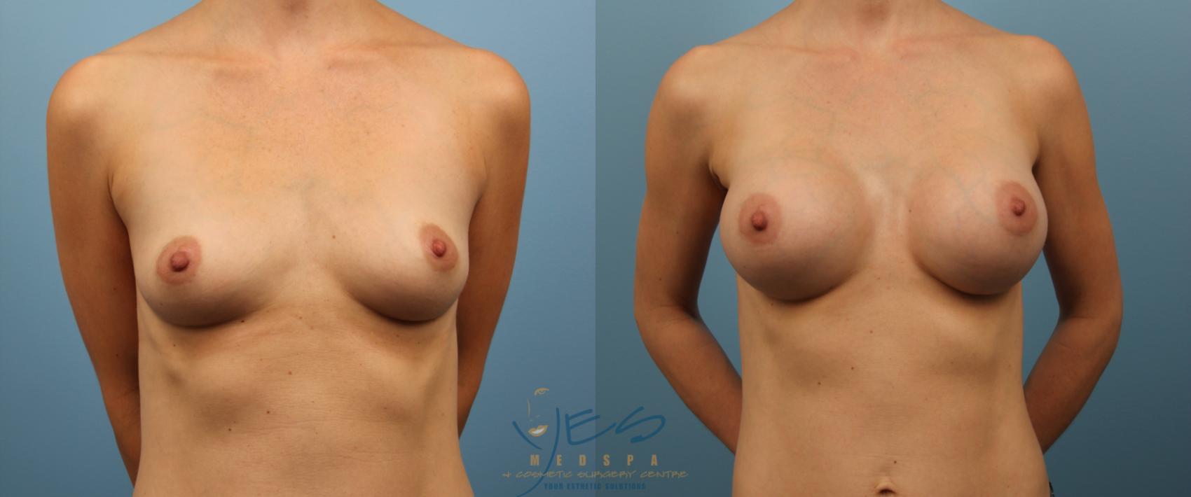 Before & After Breast Augmentation Case 141 View #1 View in Vancouver, BC