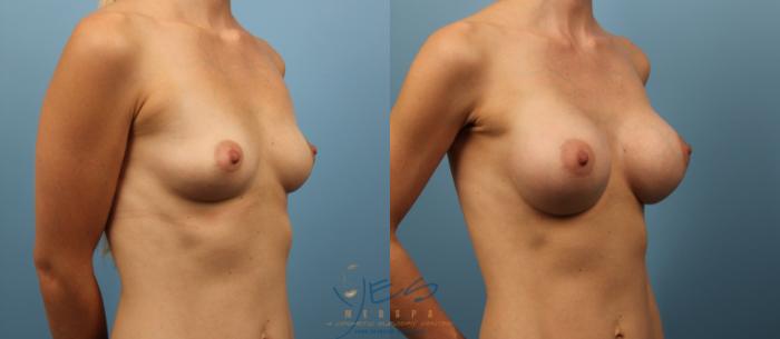 Before & After Breast Augmentation Case 141 View #2 View in Vancouver, BC