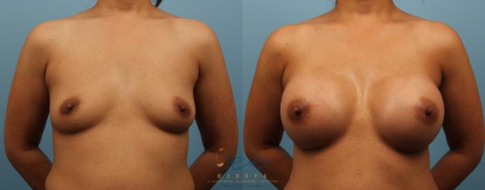 Before & After Breast Augmentation Case 147 View #1 View in Vancouver, BC