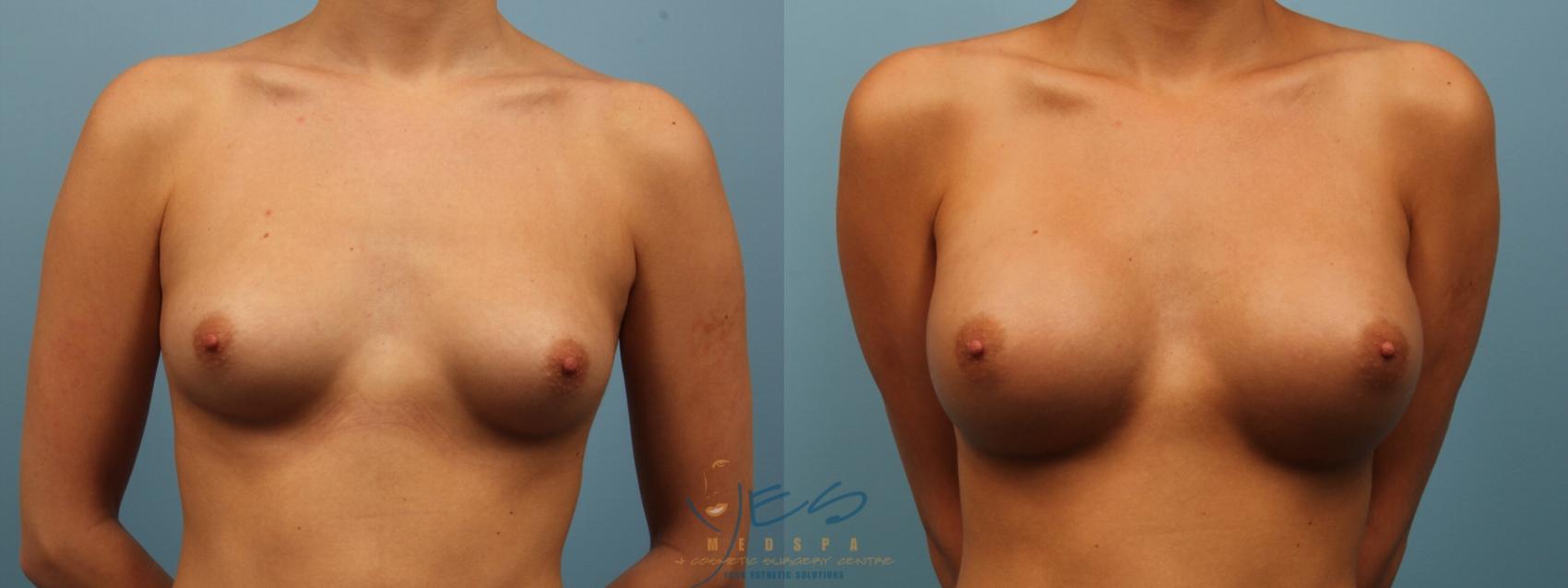 Before & After Breast Augmentation Case 153 View #1 View in Vancouver, BC